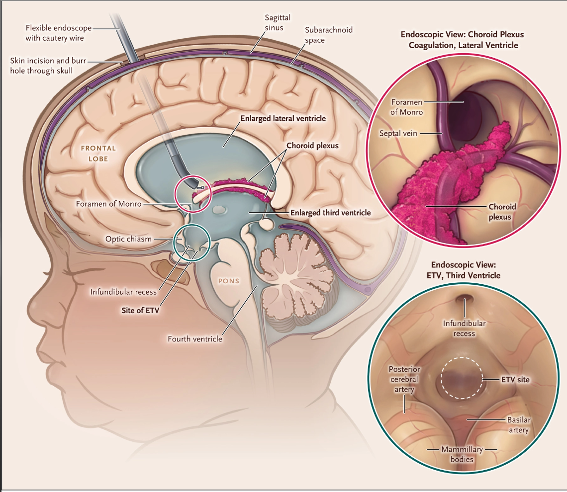 Medical diagram showing ETV procedure with endoscope creating hole in third ventricle floor and choroid plexus cauterization