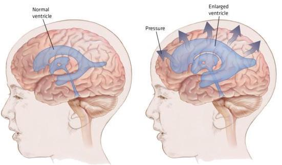 Comparison showing normal brain ventricles versus enlarged ventricles in hydrocephalus, with arrows indicating increased pressure