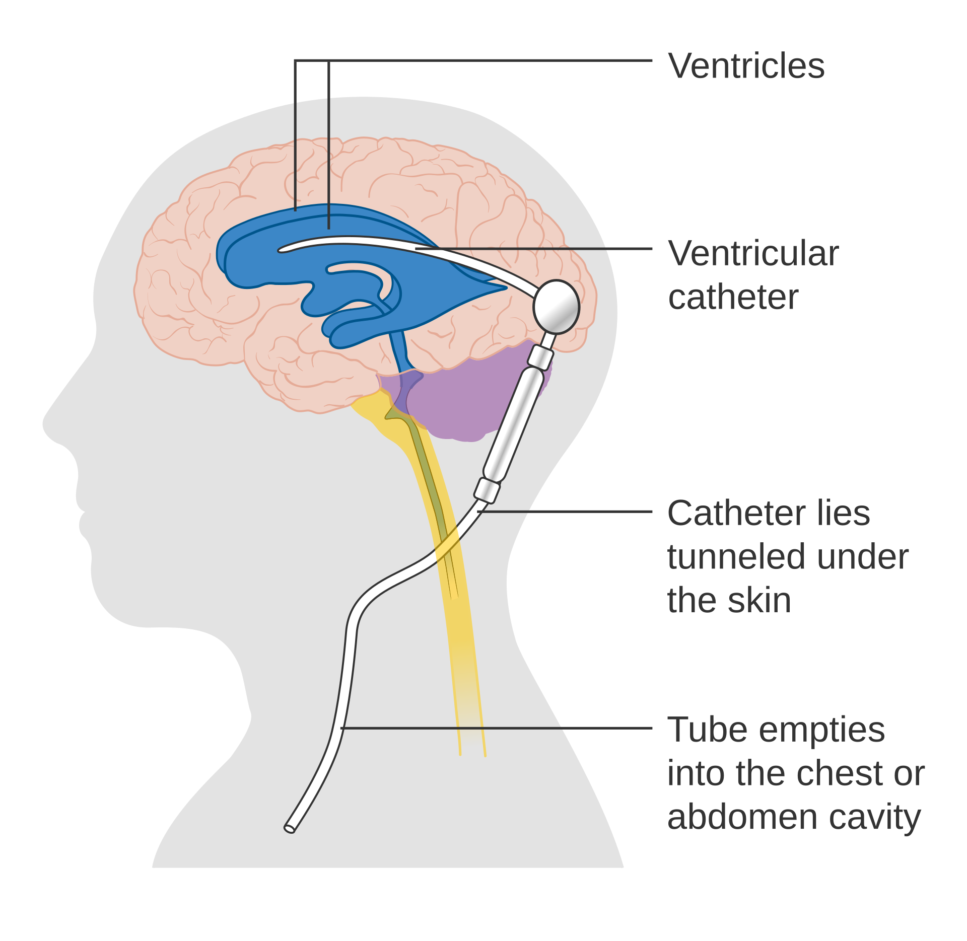 Medical diagram showing how a ventricular shunt works, with catheter in brain ventricles draining fluid through tubing under the skin to the abdomen